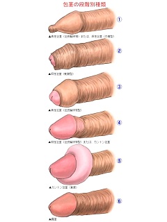包皮过长的图片